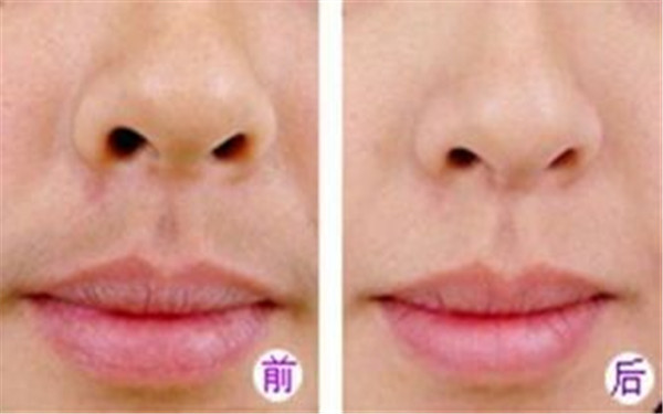 南京市冷冻溶脂溶脂价格需多少-价格在12368元起
