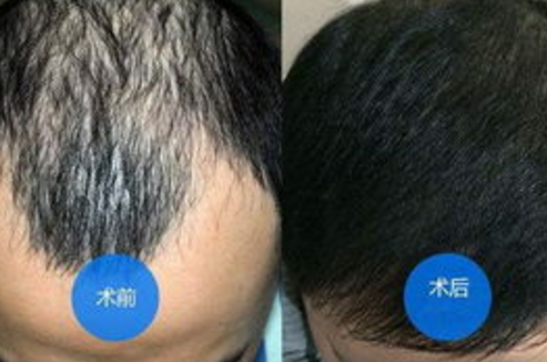 西宁鼻综合隆鼻价目表（近6个月均价为：3902元）